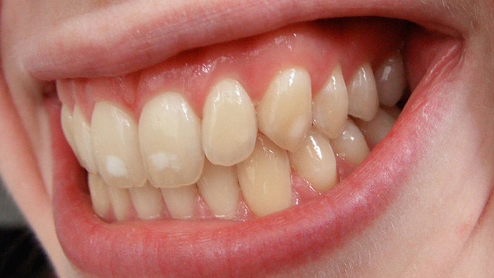 9 Dấu hiệu của bệnh sâu răng bạn cần lưu ý