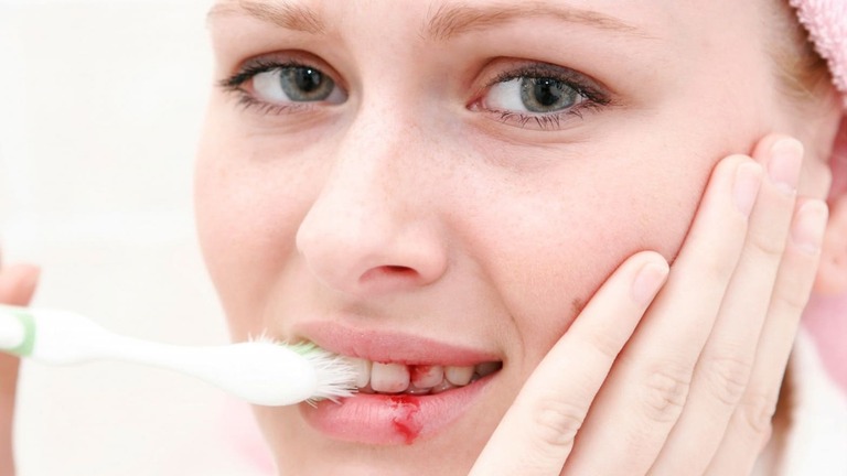 9 Dấu hiệu của bệnh sâu răng bạn cần lưu ý