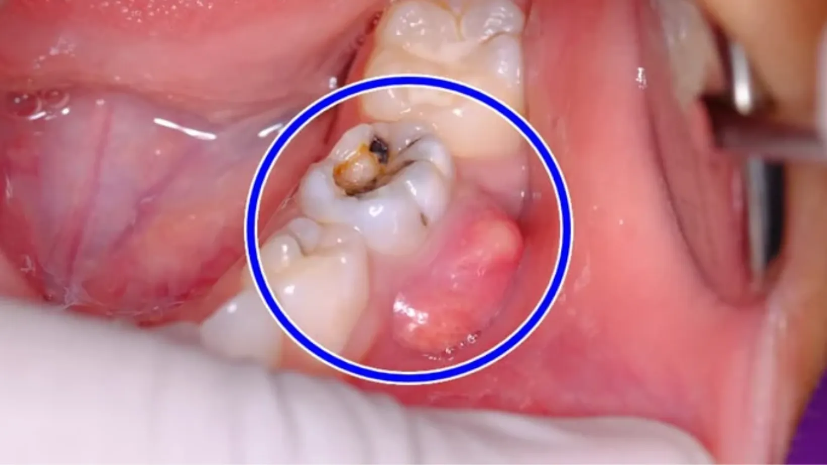 Nhiễm trùng chân răng là gì?
