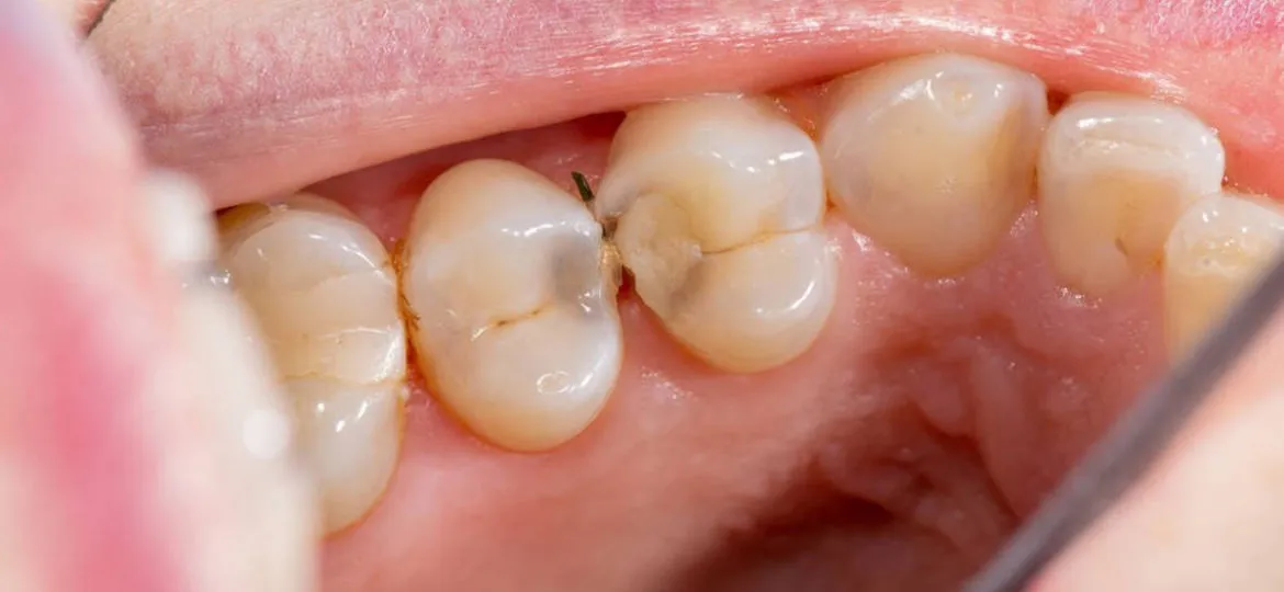 Sâu răng tự lành có được hay không?