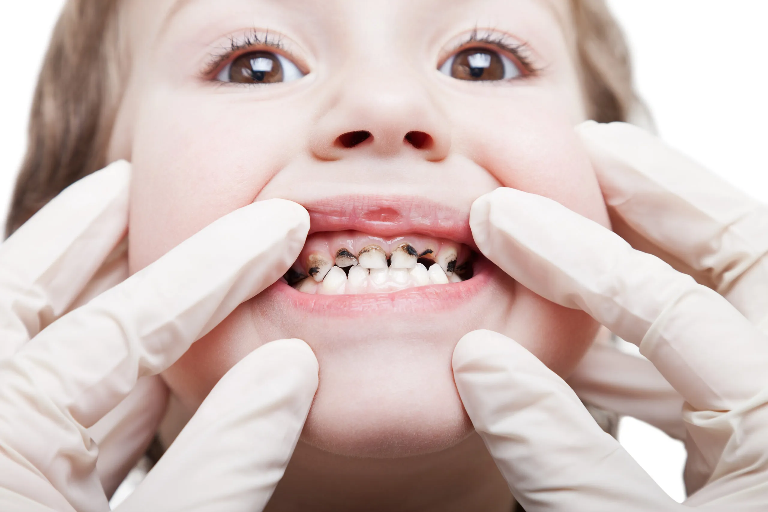 Men răng yếu là một trong các nguyên nhân khiến trẻ bị sâu răng