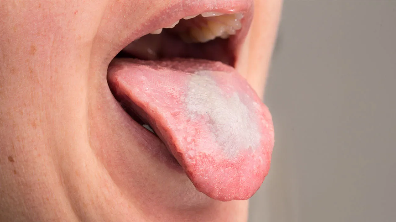 Bệnh nấm lưỡi là gì?
