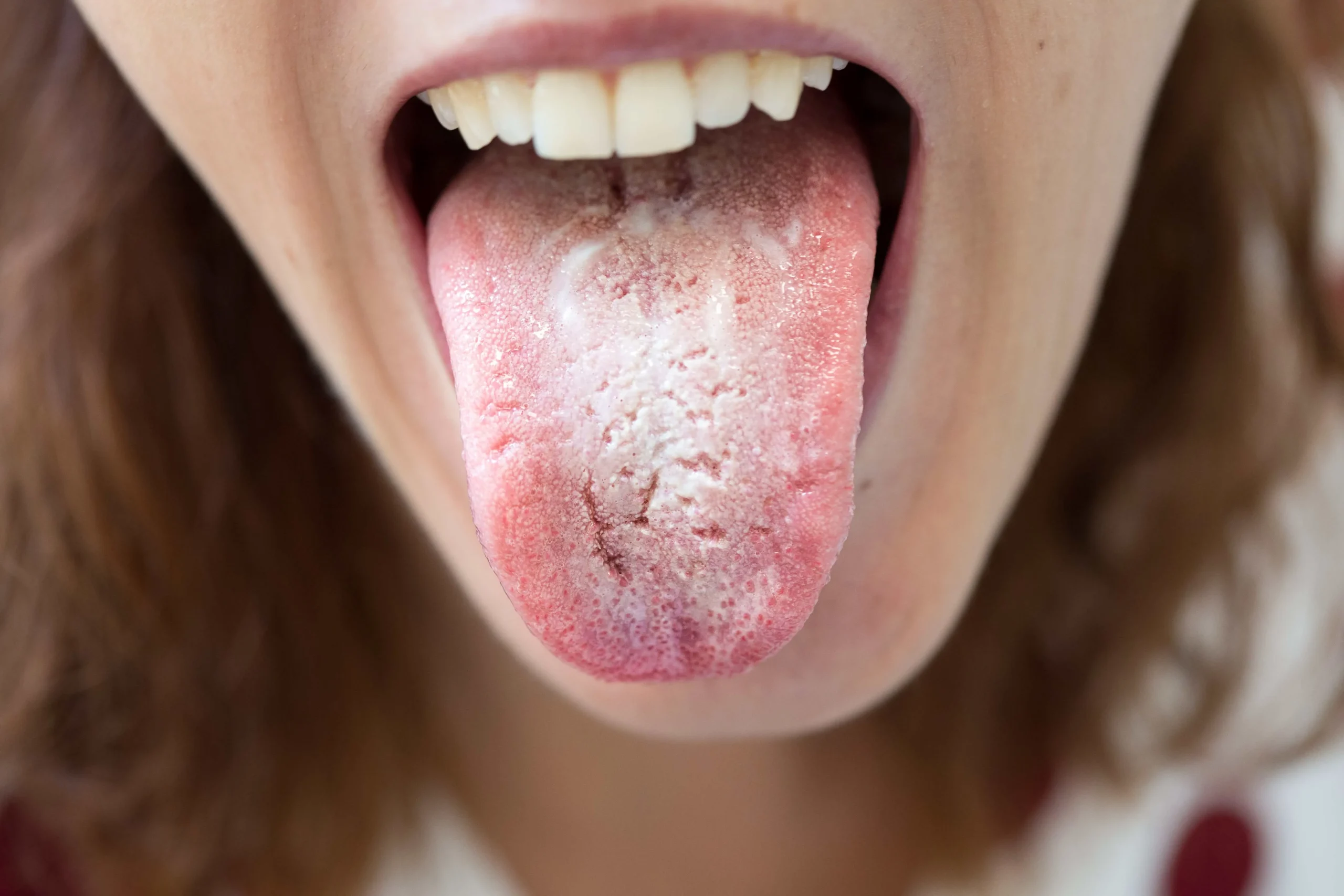 Nấm lưỡi đôi khi có biểu hiện lưỡi xuất hiện màu trắng kem