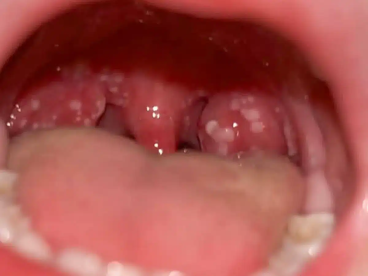 Bệnh nhân bị nổi hạt trong miệng