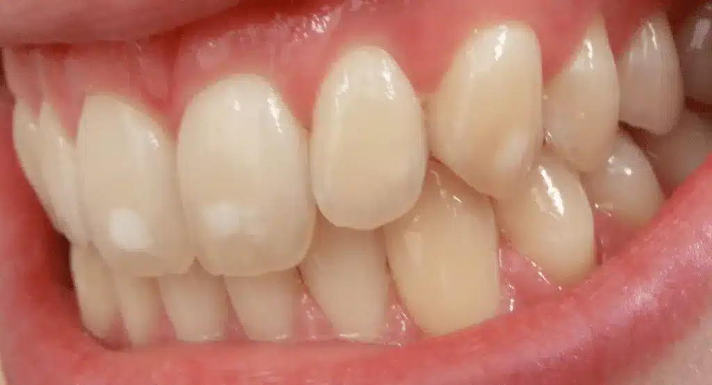 Bệnh thiểu sản men răng là nguyên nhân dẫn đến lộ ngà răng