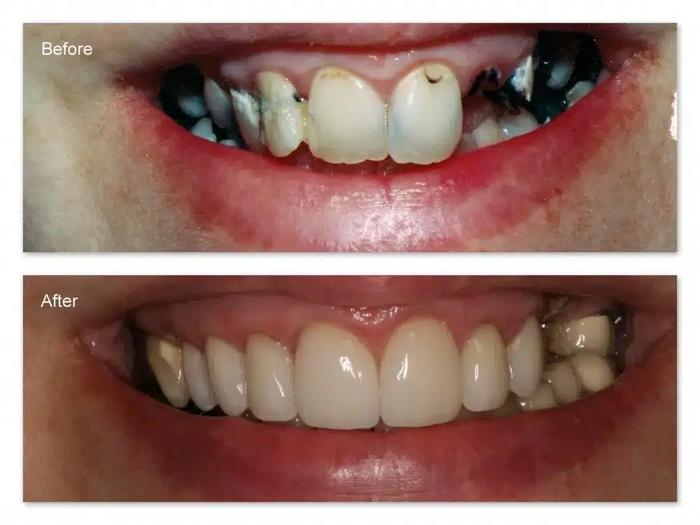 Bọc răng sứ - giải pháp cho răng bị sâu nặng
