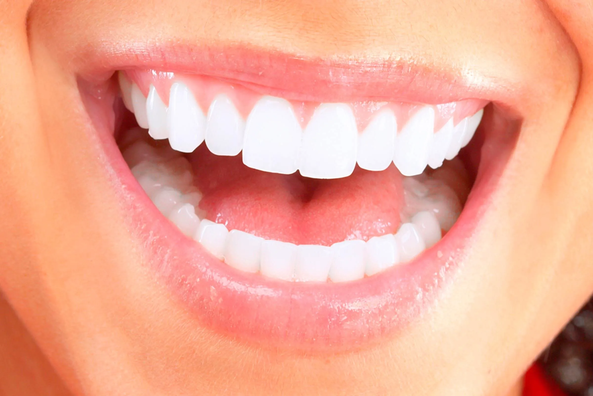 Bọc răng sứ đã lấy tủy để kéo dài tuổi thọ của răng thật