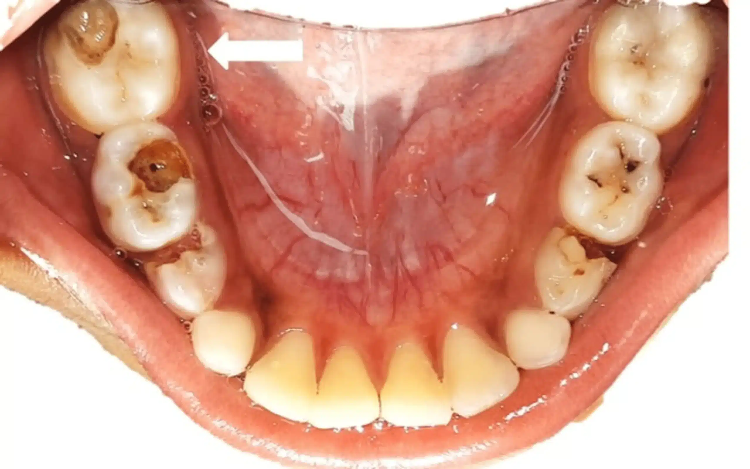 Tủy răng hoại tử là bệnh răng miệng nghiêm trọng