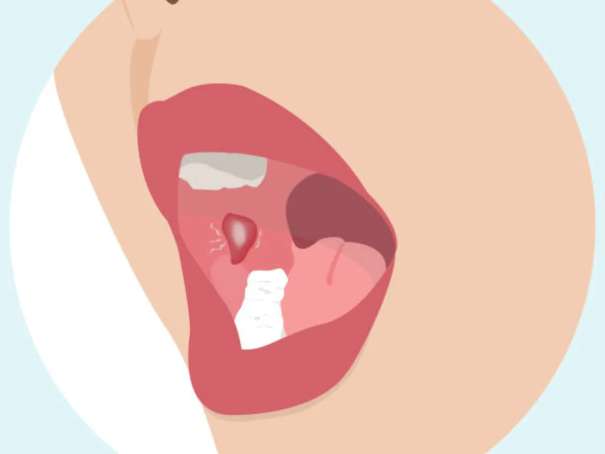 Ung thư miệng là bệnh răng miệng nguy hiểm