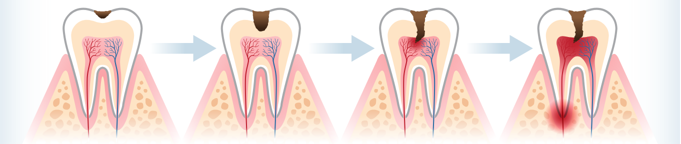 Sâu răng lan dần vào tủy răng gây viêm tủy và abcess chóp răng