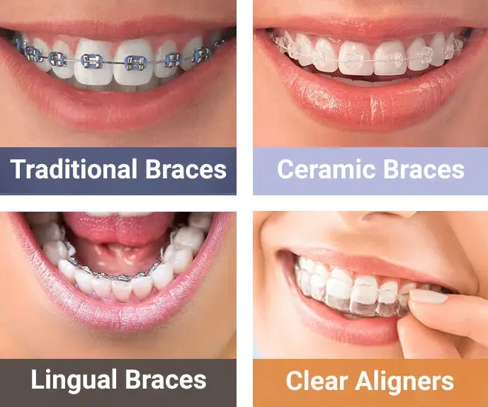 Các loại niềng răng phổ biến hiện nay là gì?