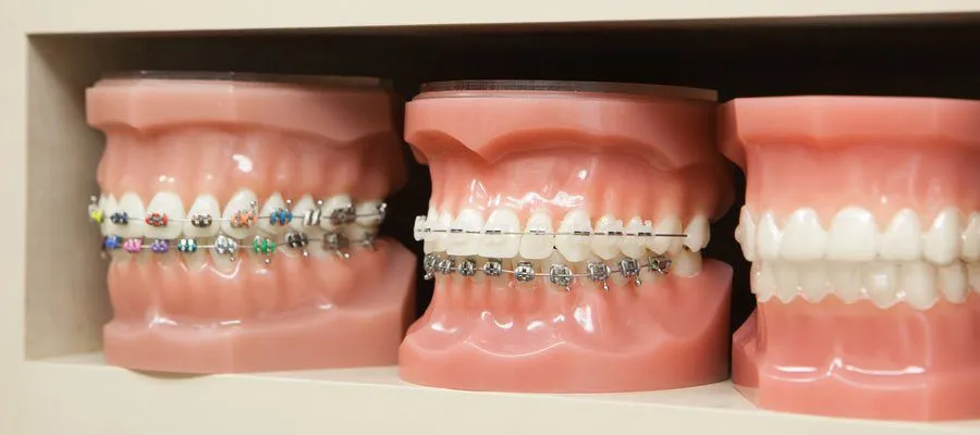 Các loại mắc cài niềng răng nào là hiệu quả?