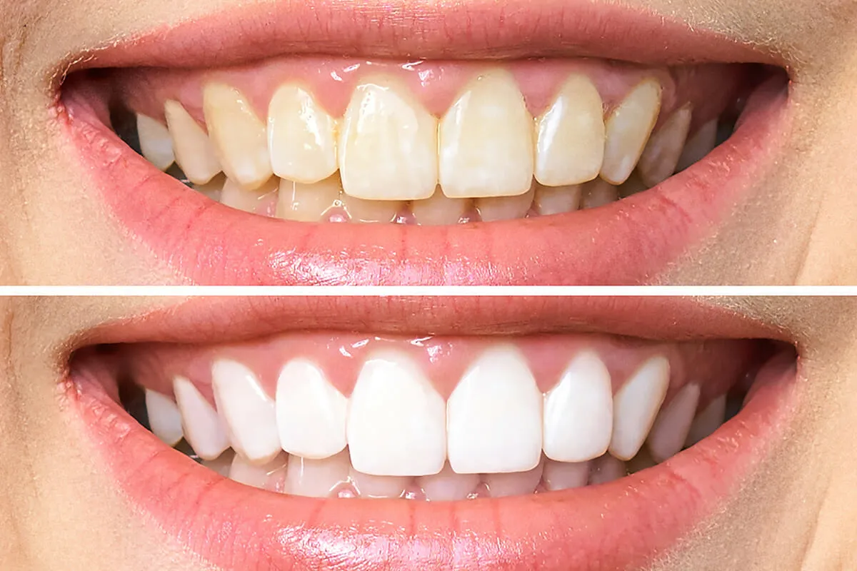 Những trường hợp nào nên tẩy trắng răng?