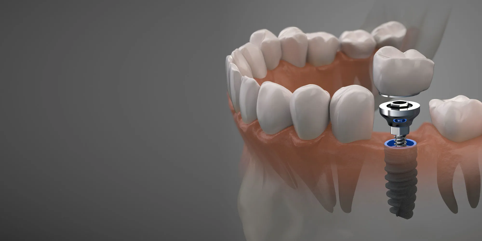 Cấy ghép implant khi bệnh nhân mất răng