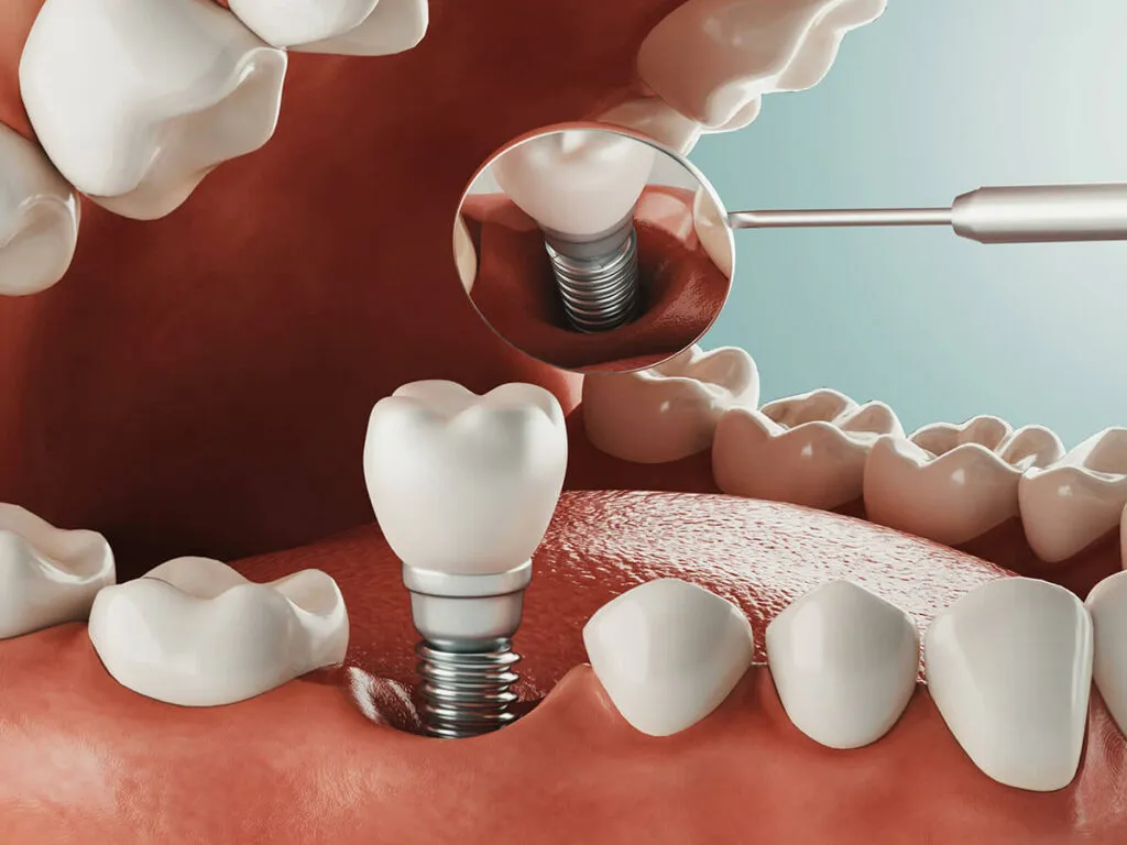 Phương pháp cấy ghép răng implant