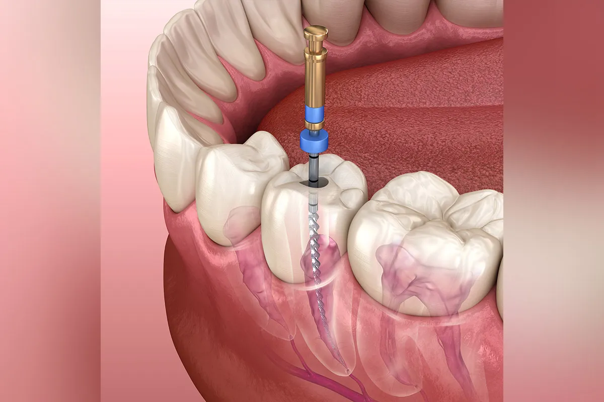 Phương pháp chữa tủy răng điều trị răng sâu vào tủy