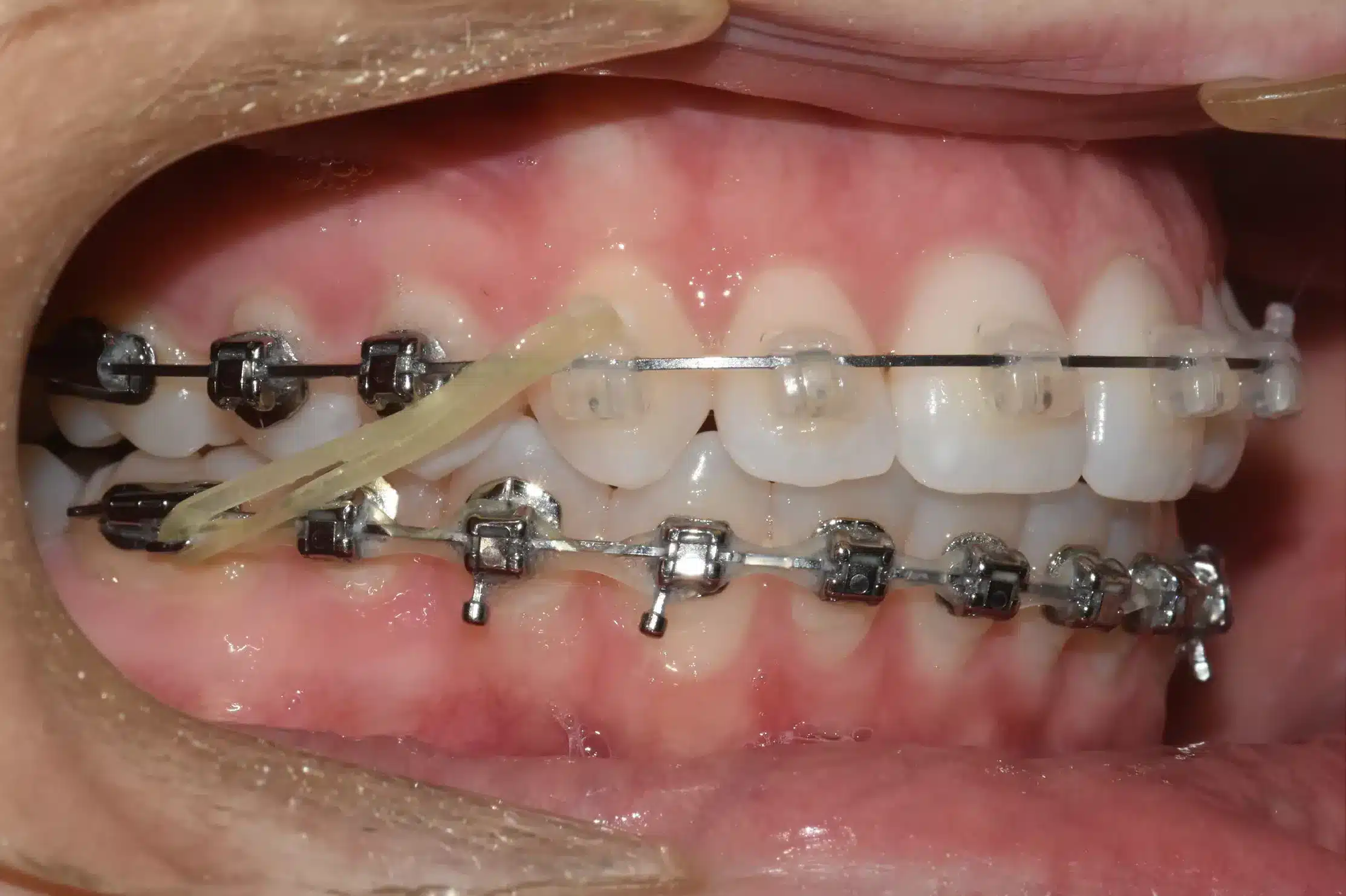 Thun niềng răng liên hàm nhìn khá giống dây thun thông thường có độ đàn hồi rất cao, làm bằng cao su siêu bền và an toàn