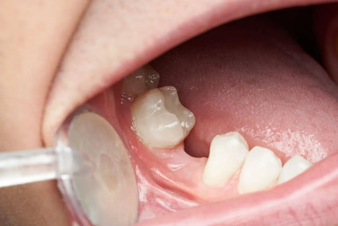 Có nguy cơ mất răng vĩnh viễn