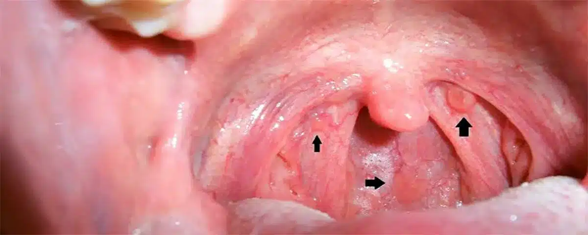 Dấu hiệu của ung thư khoang miệng