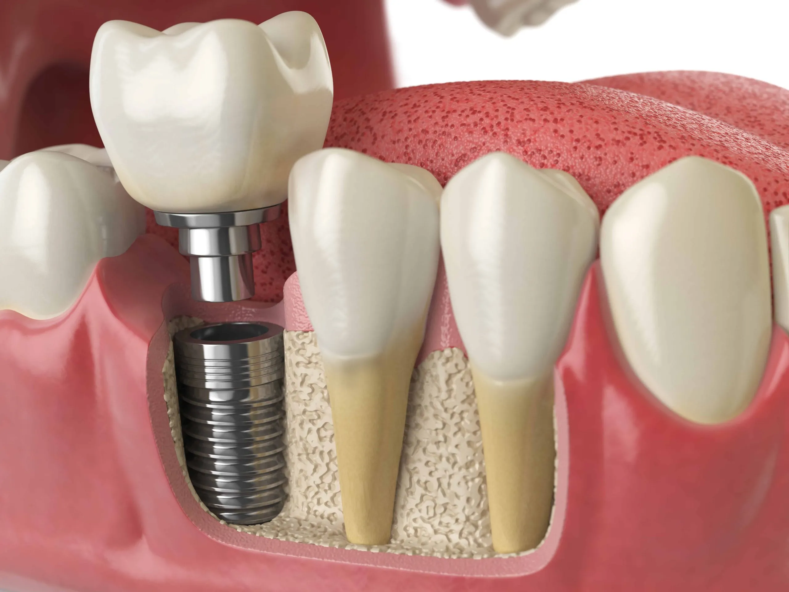 Trồng răng implant khắc phục hiệu quả tình trạng mẻ răng