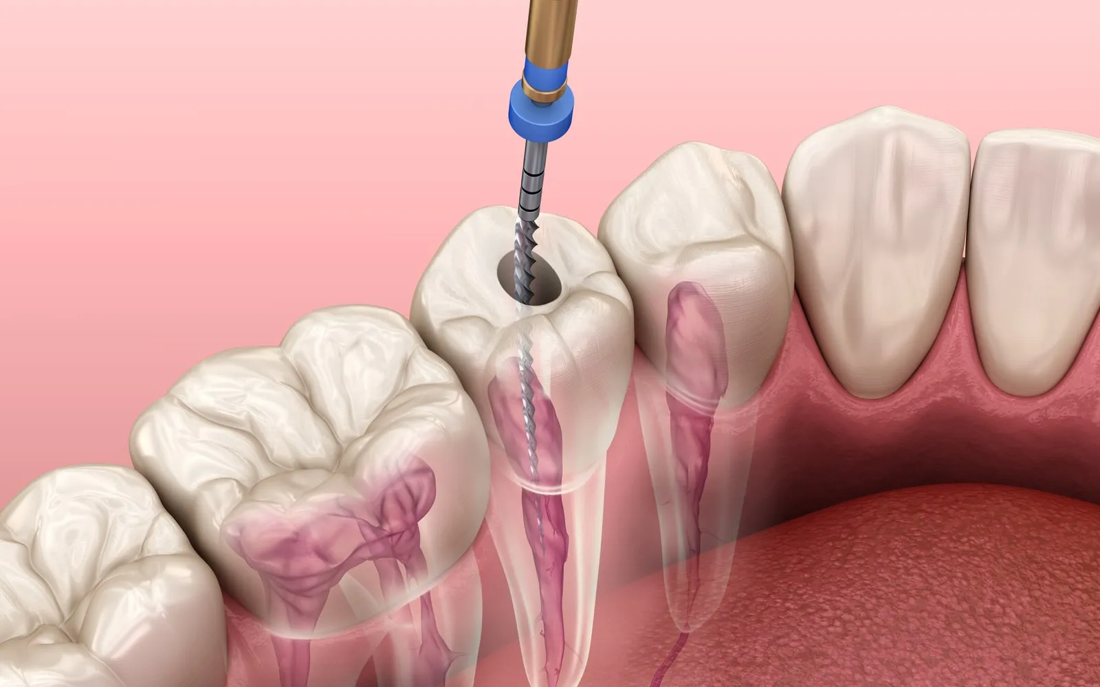Chữa tủy răng (điều trị nội nha)