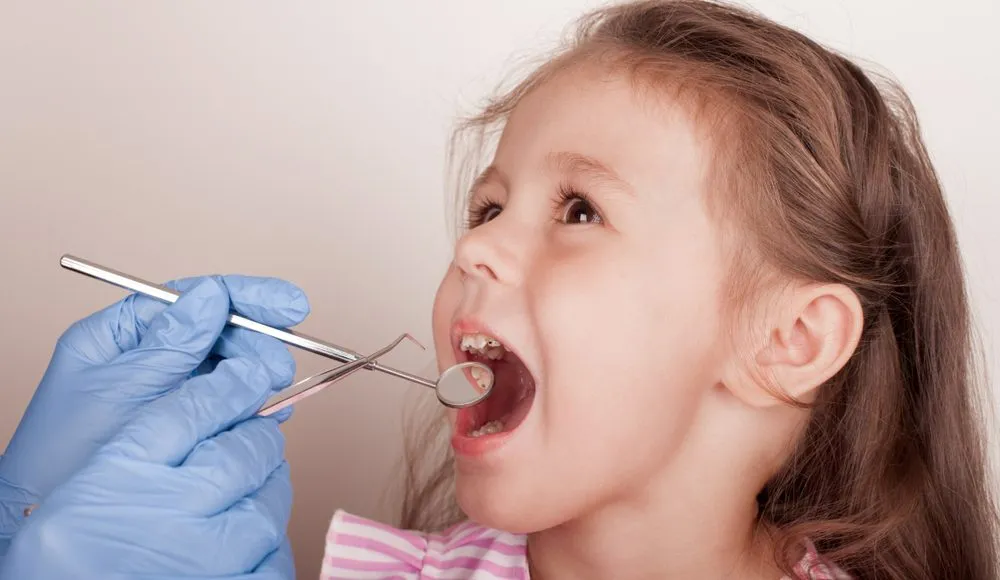 Khi phát hiện trẻ bị sâu răng hàm cần điều trị sớm để không làm mất răng