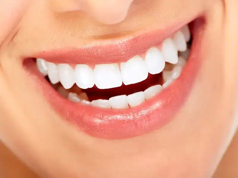 Niềng răng trong suốt Invisalign được đánh giá là phương pháp điều trị hiệu quả, đáng đầu tư