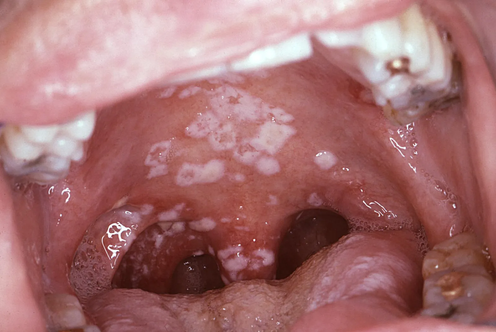 Hình ảnh  bệnh nấm miệng