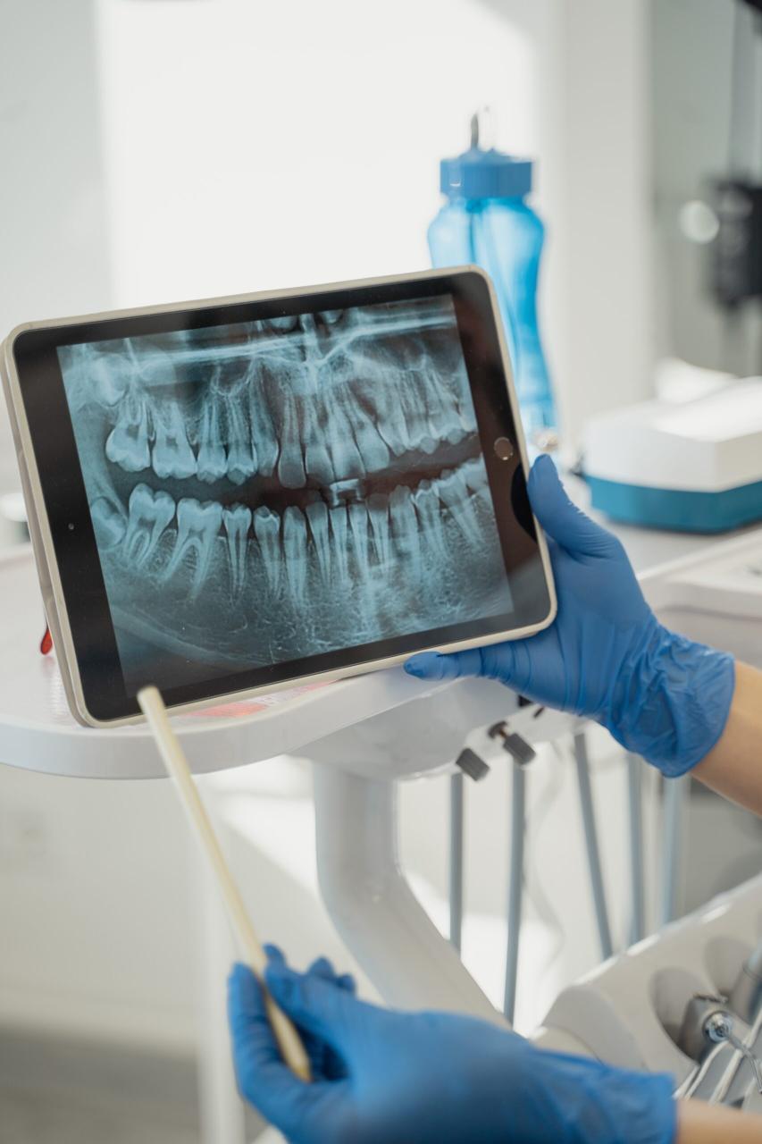 Hướng dẫn chăm sóc răng sau cấy implant