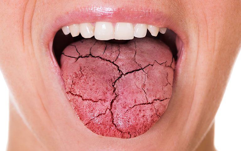 Rát lưỡi có ảnh hưởng đến sức khỏe toàn diện của cơ thể không?
