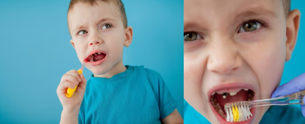 Vệ sinh răng miệng chưa tốt khiến răng bé bị sâu