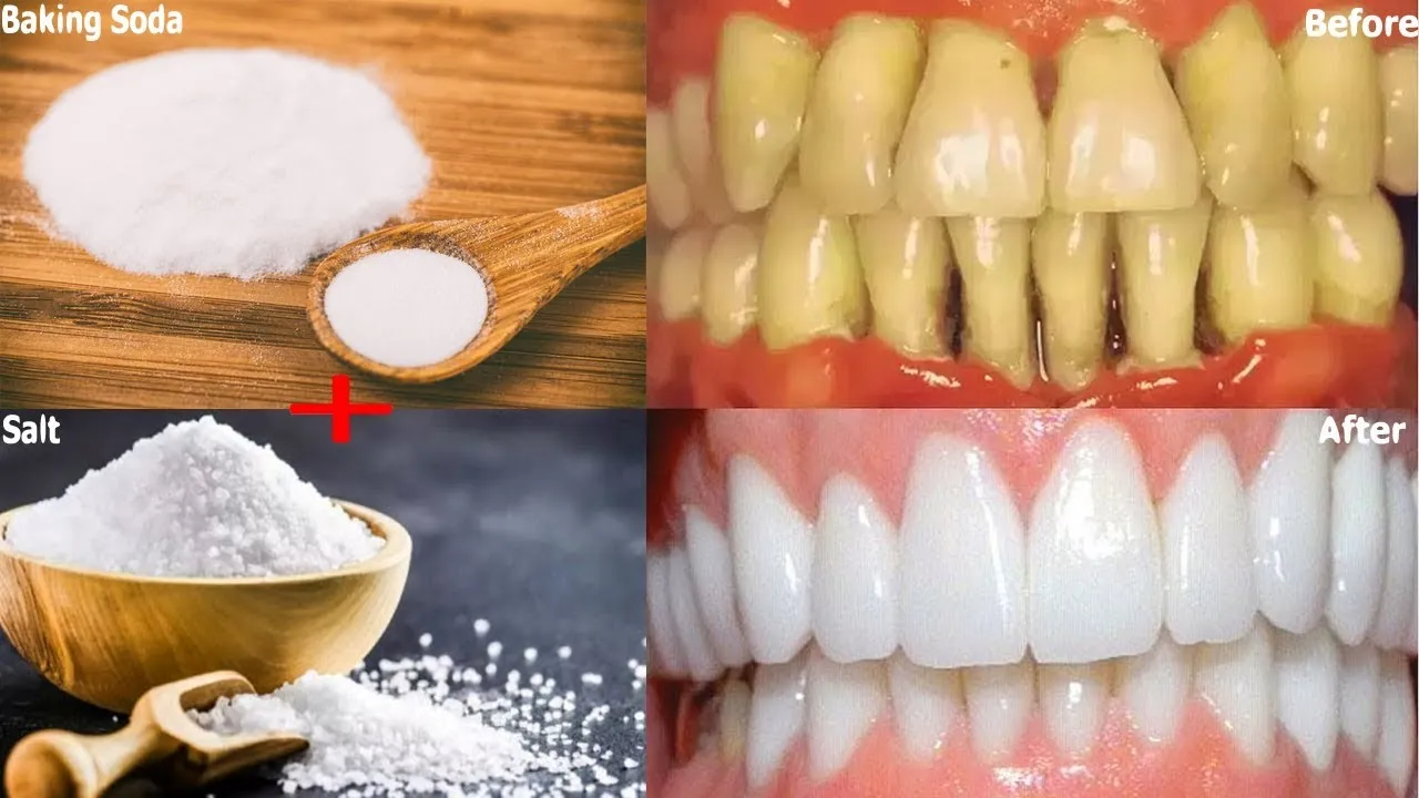 Phương pháp làm trắng răng bằng baking soda và muối