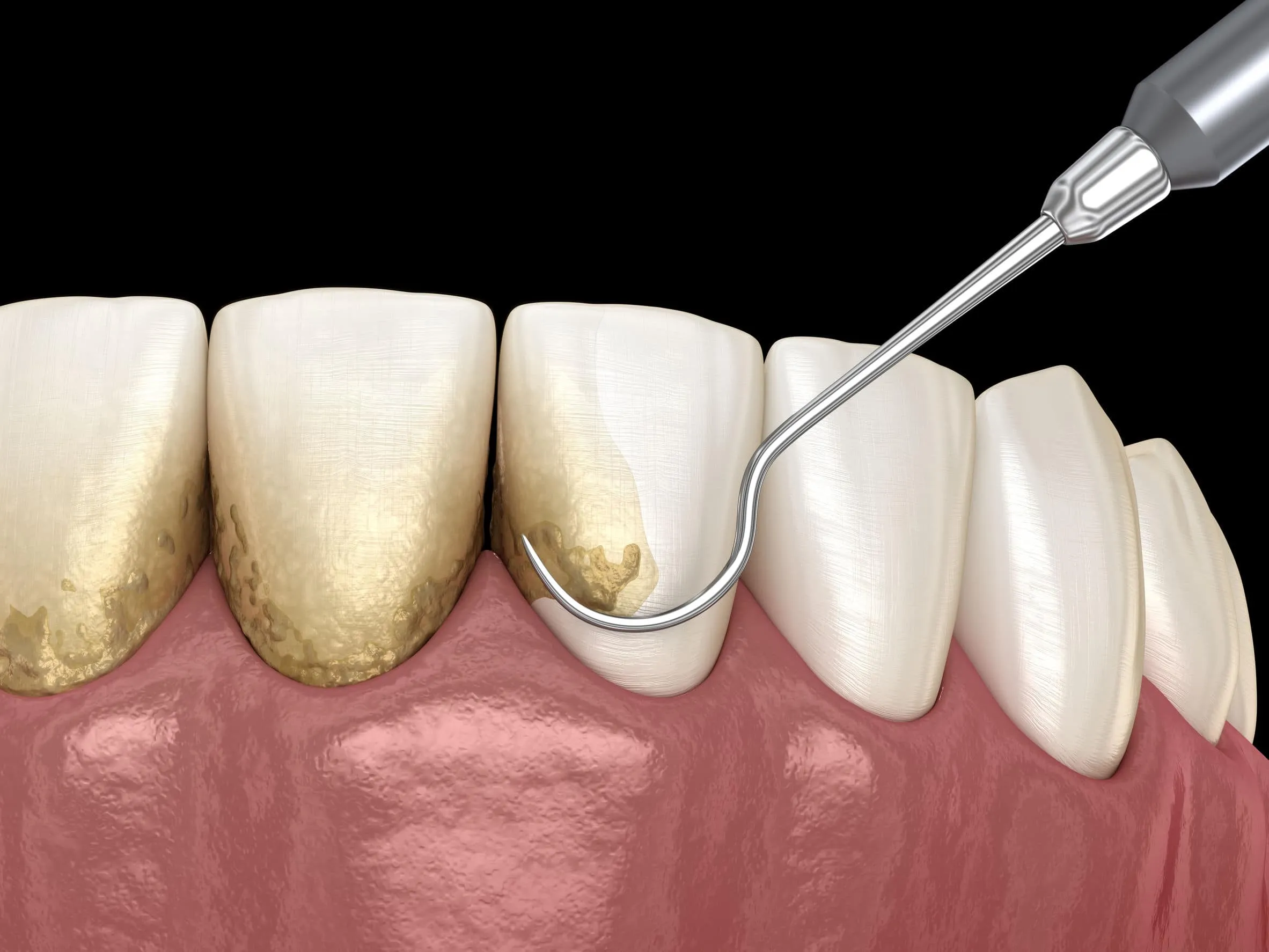 Lấy cao răng định kỳ cải thiện sức khỏe răng miệng
