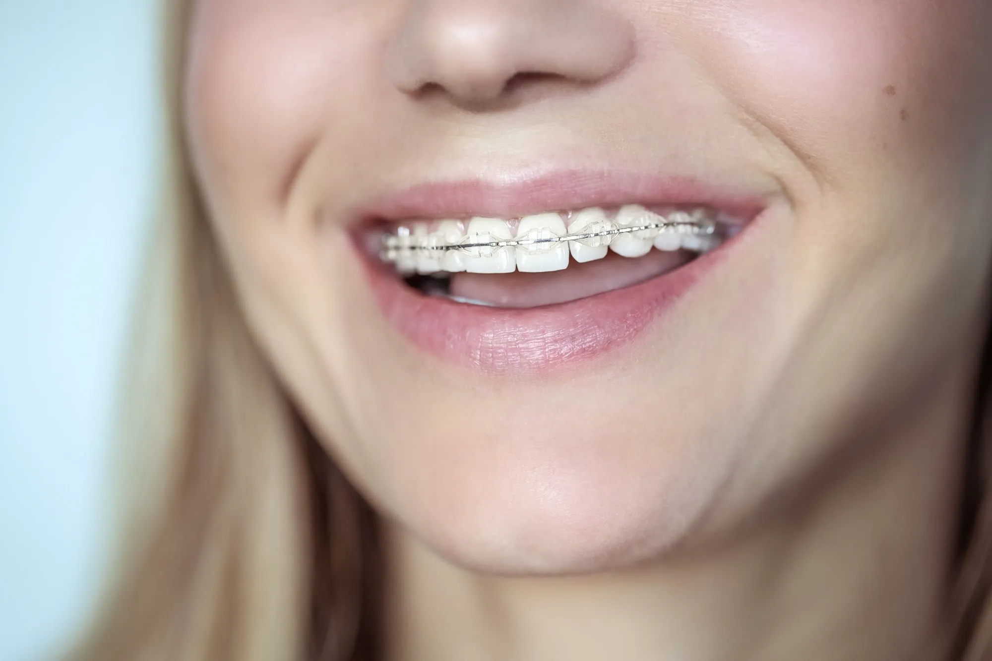 Niềng răng mắc cài sứ tương tự như mắc cài kim loại nhưng lại có tính thẩm mỹ cao hơn