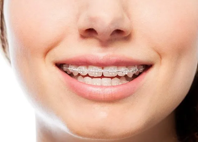 Mắc cài sứ có chất liệu là sứ hoặc hợp kim gốm với màu trắng gần giống với màu sắc tự nhiên của răng