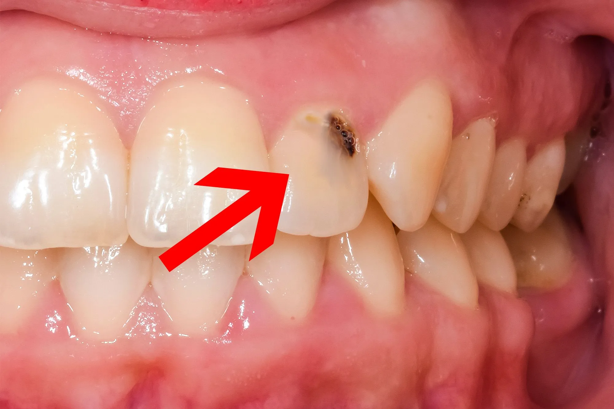 Mảng bám gây bào mòn men răng và gây sâu răng