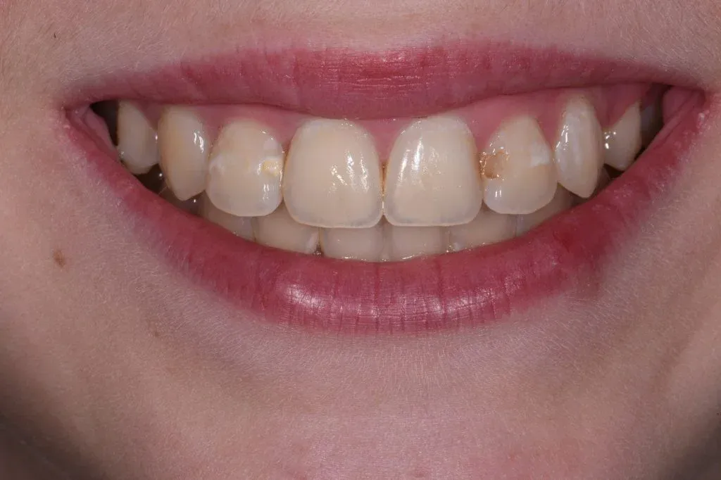 Men răng yếu dễ mắc tình trạng sâu kẽ răng