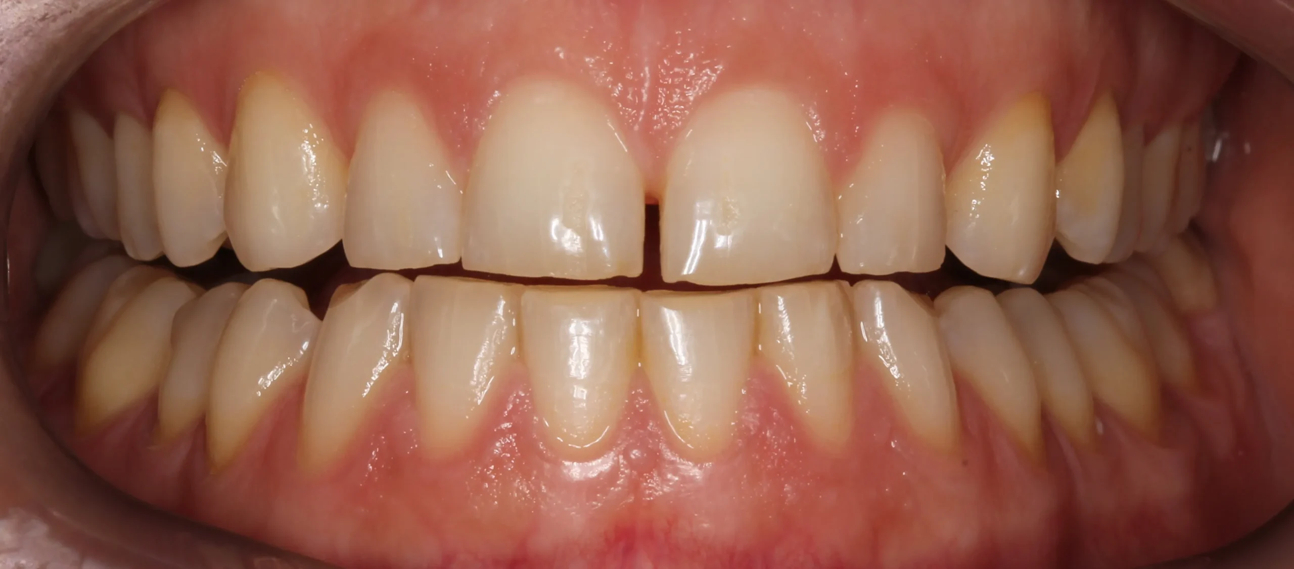 Mòn răng khiến răng dễ bị sâu đen