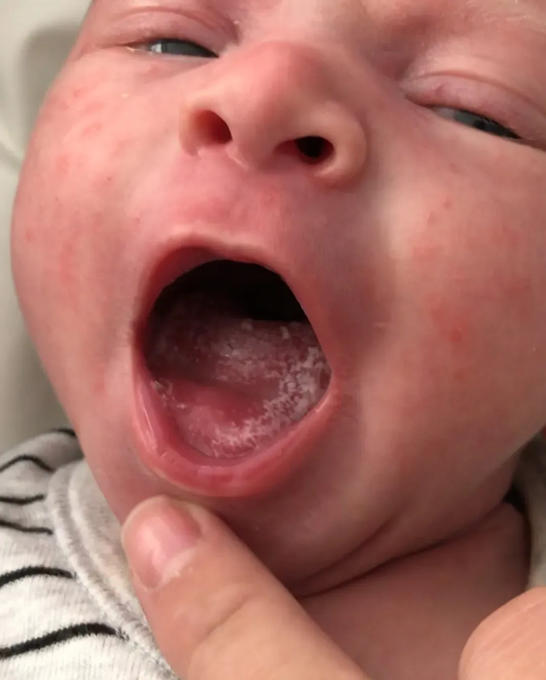 Hình ảnh nấm lưỡi ở trẻ sơ sinh