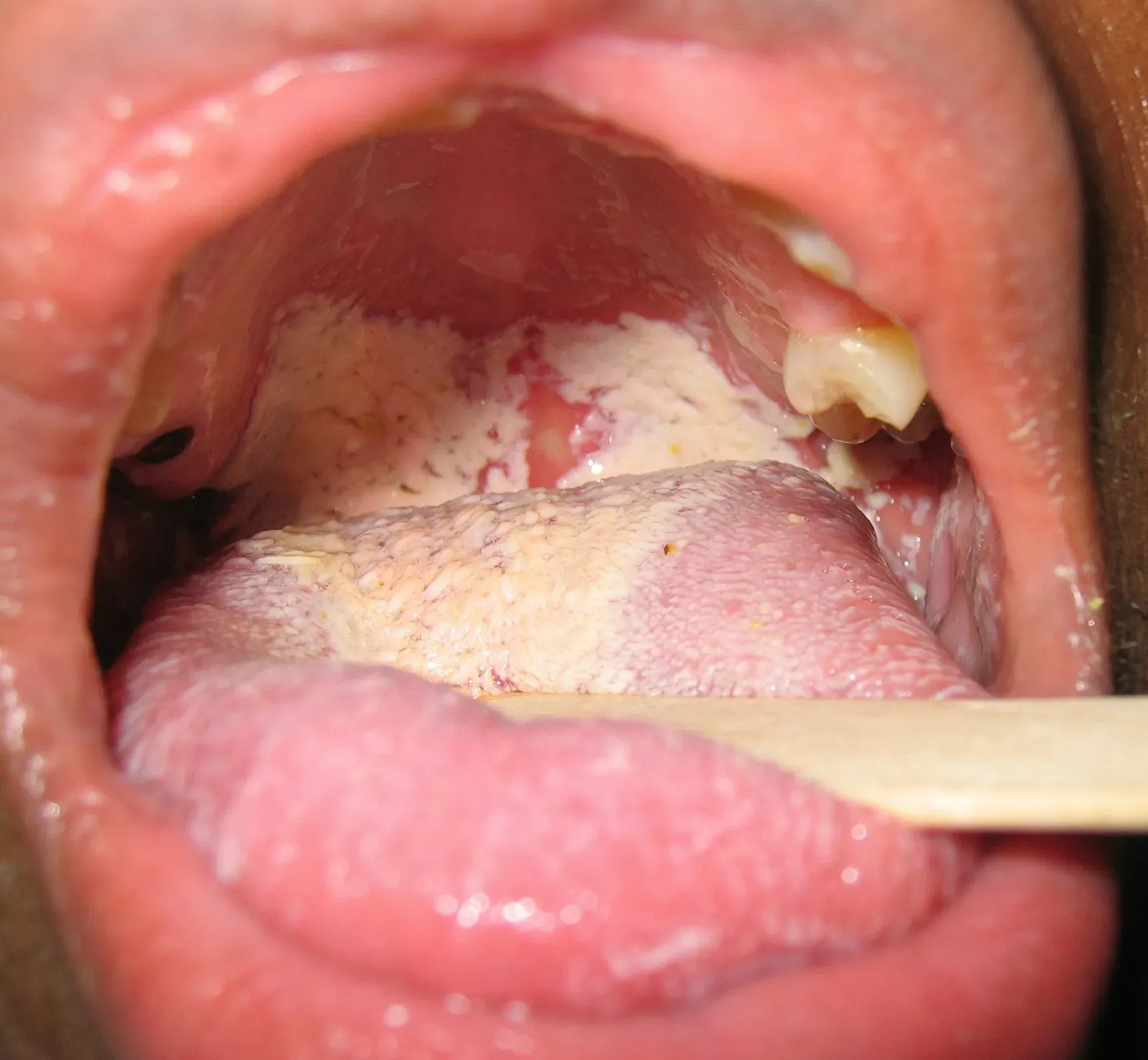 Nấm miệng ở người có khả năng miễn dịch yếu có thể lan đến amidan, hầu họng