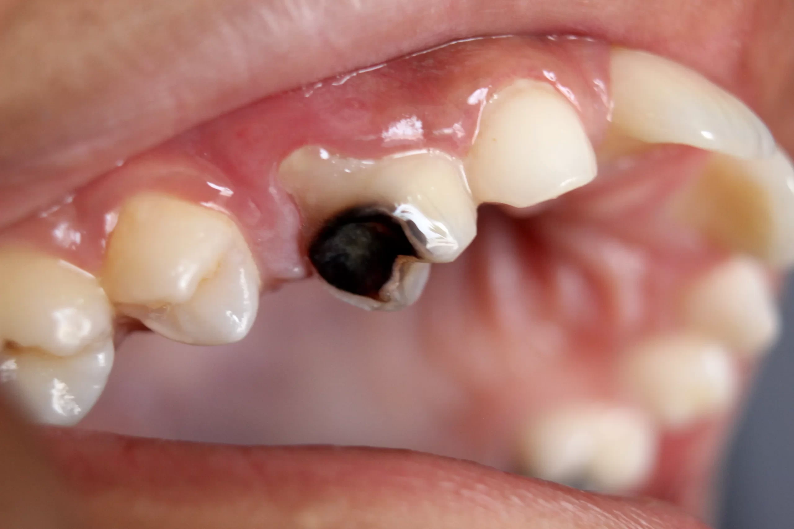 Sâu răng quá nặng có nguy cơ mẻ răng, vỡ răng hoặc mất răng 