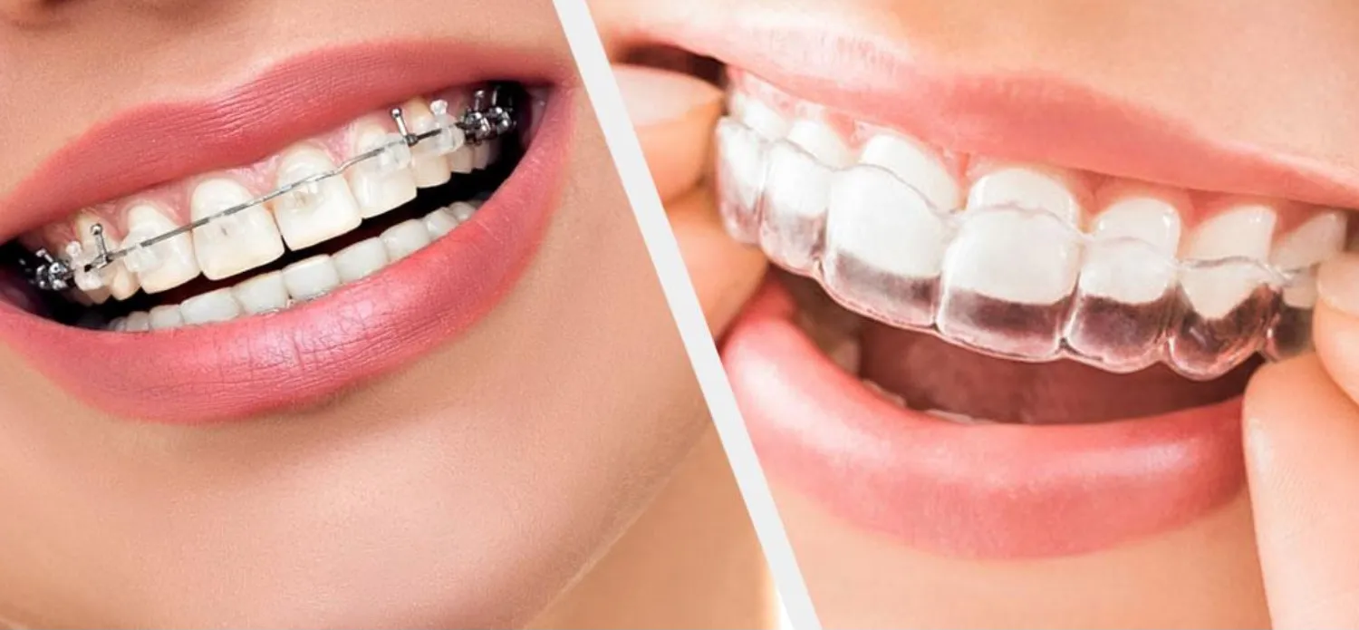 Người đang niềng răng nên dùng nước súc miệng có chứa fluoride