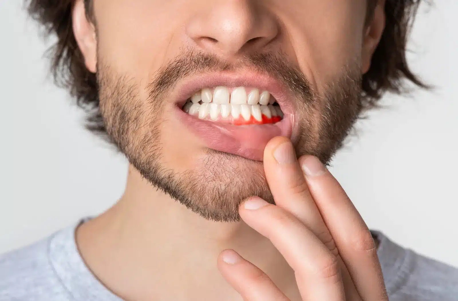 Nhiễm trùng là biến chứng nguy hiểm sau khi nhổ răng khôn