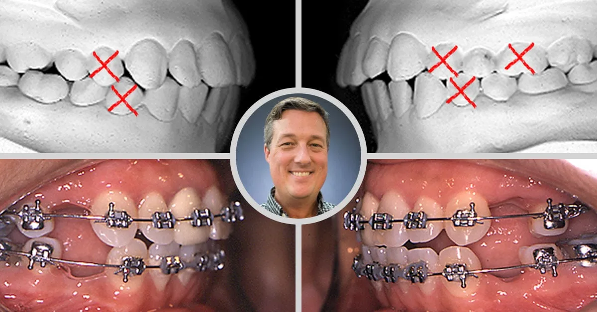 Răng bị hô hoặc móm nặng xảy ra khi thân răng to hoặc thừa răng trên khung hàm nhỏ, khiến răng mọc hướng ra ngoài