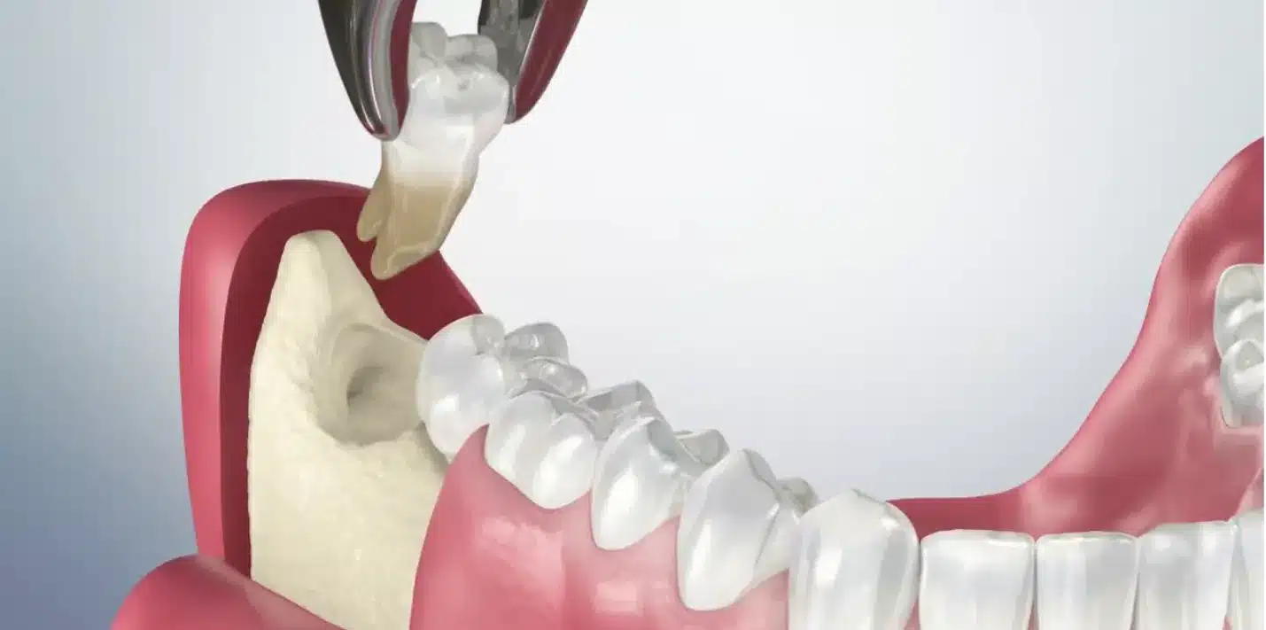 Nhổ răng khôn ngay khi nó gây ra những vấn đề sức khỏe