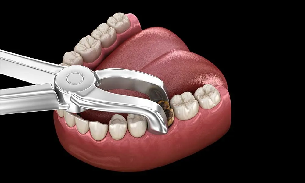 Nhổ răng sâu có ảnh hưởng gì không?