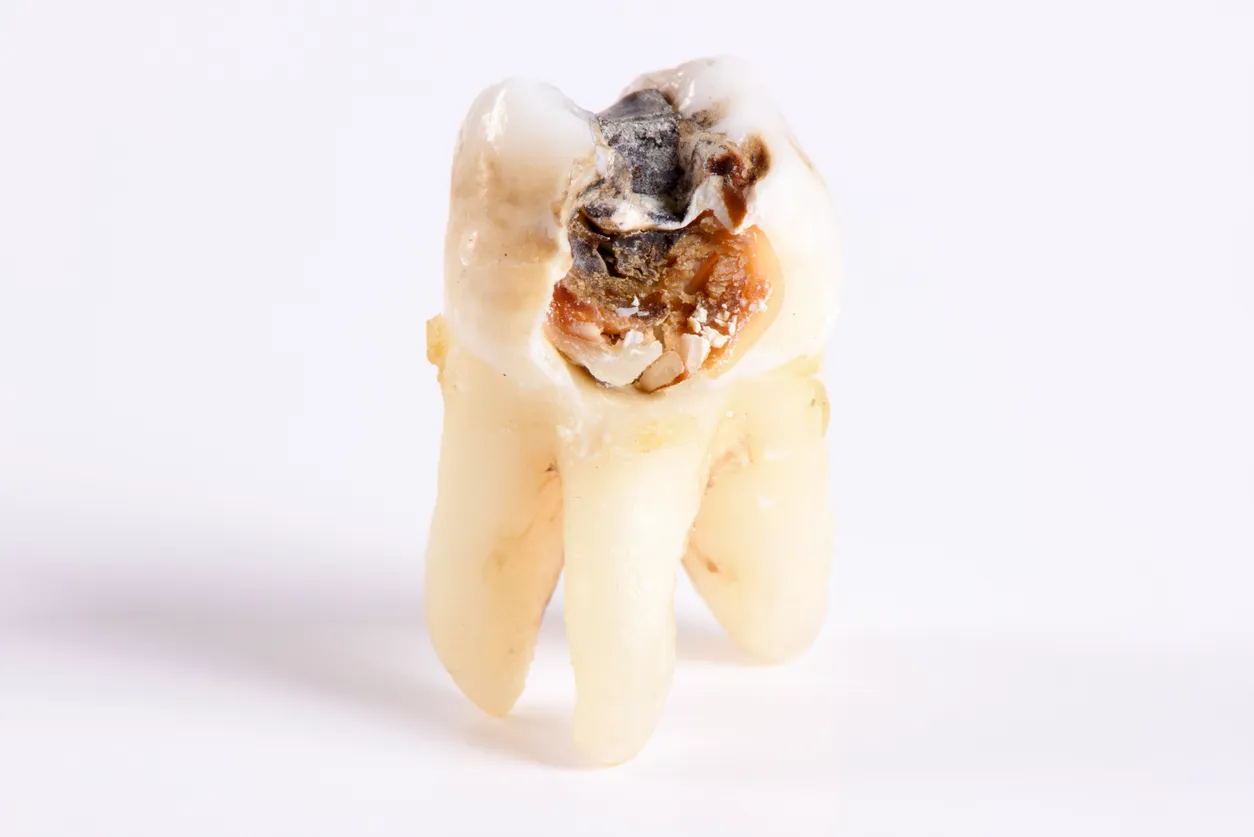 Nhổ răng khôn bị sâu vỡ sớm thì có thể ngăn chặn được nhiều biến chứng nguy hiểm đến sức khỏe