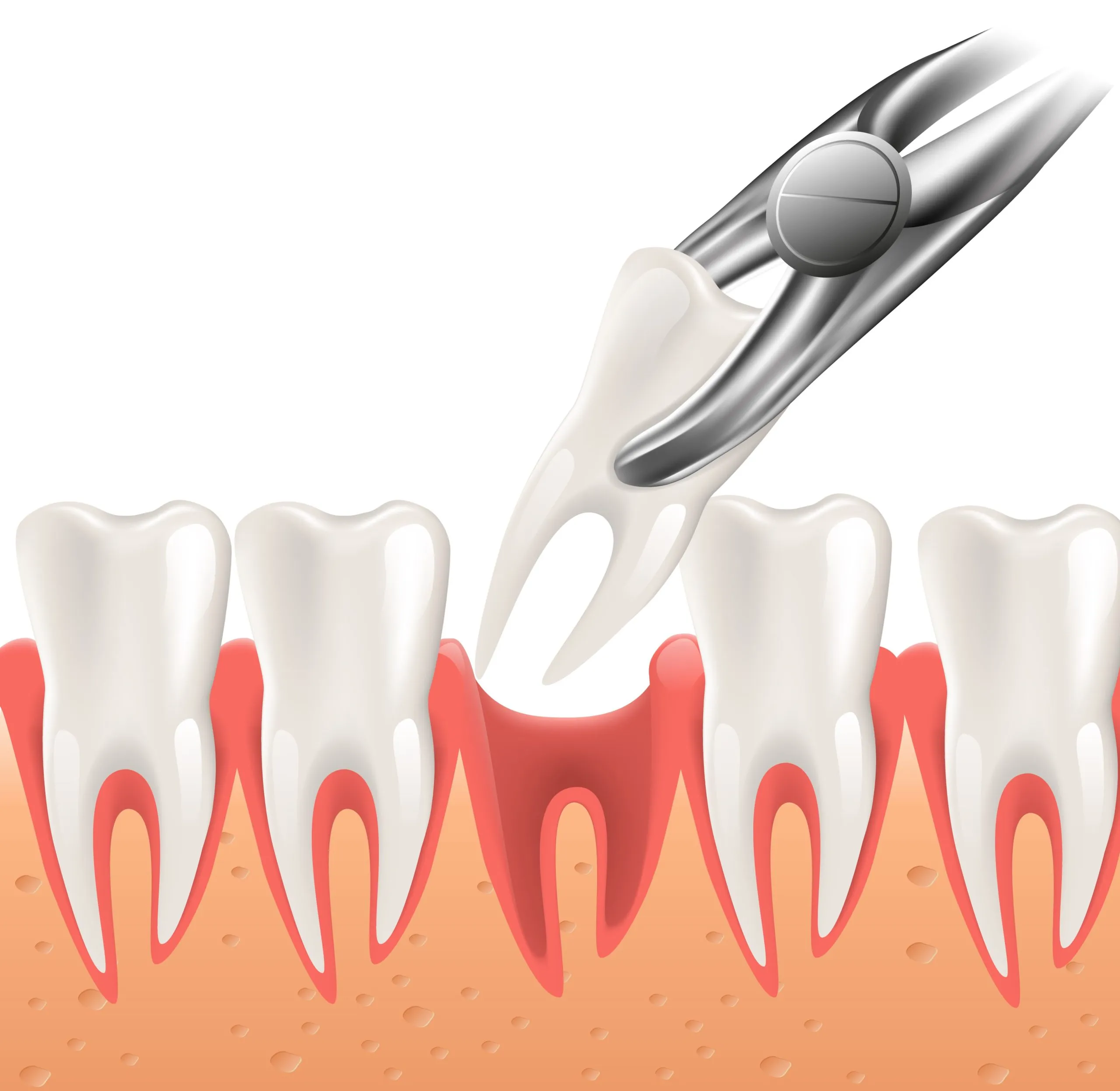 Sau khi nhổ răng sẽ hình thành cục máu đông 