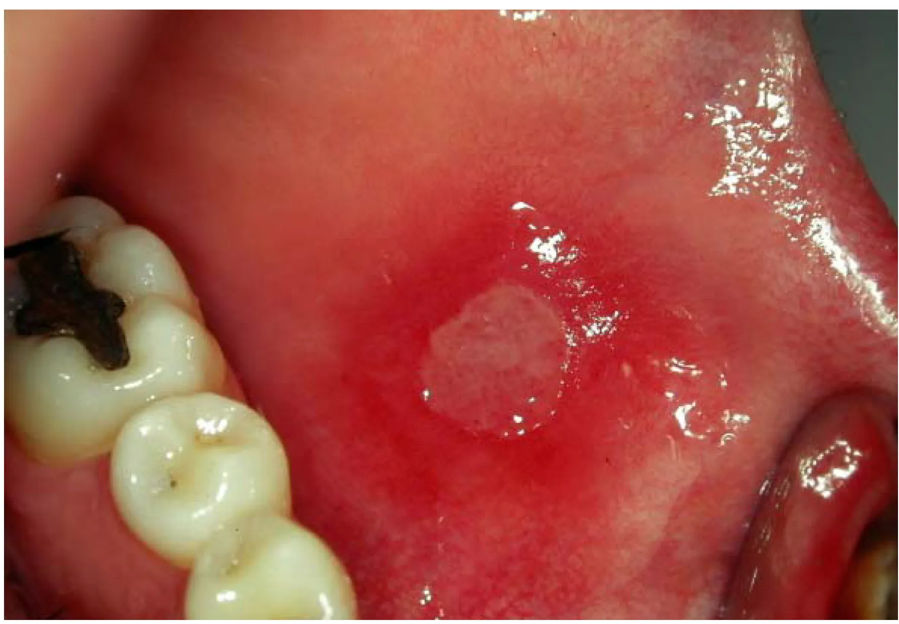 Niêm mạc miệng có thể bị kích ứng khi dùng dung dịch súc miệng có chứa cồn