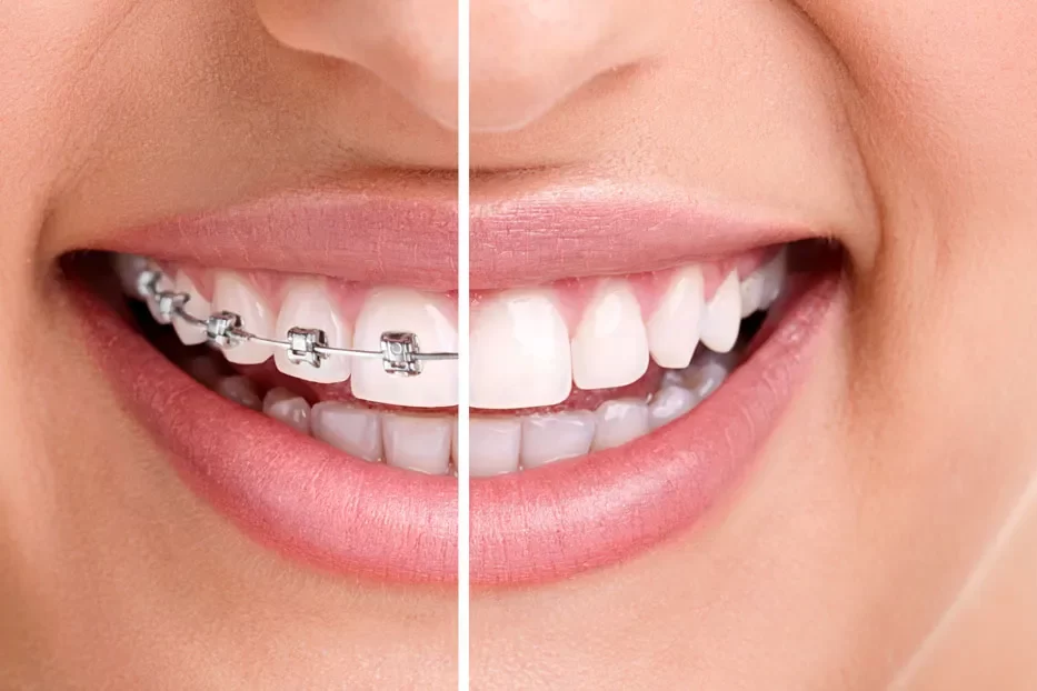 Các tác hại của niềng răng là gì?